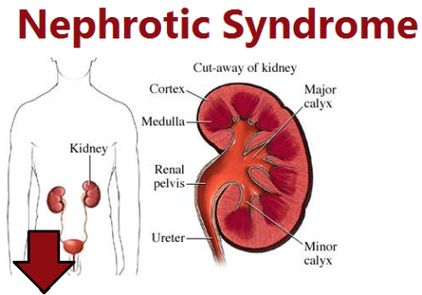 Image result for nephrotic syndrome